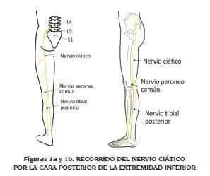 liberar el nervio ciático